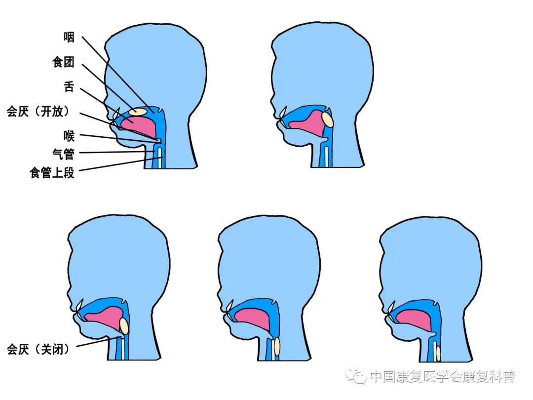 正常吞咽过程吞咽障碍是指无法将食物由口腔送入胃内和胃排空异常,可