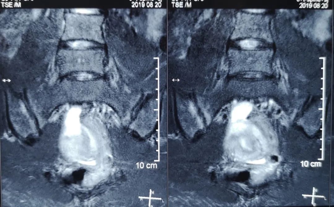 67腰部反复疼痛核磁提示骶髂关节炎一定是强直
