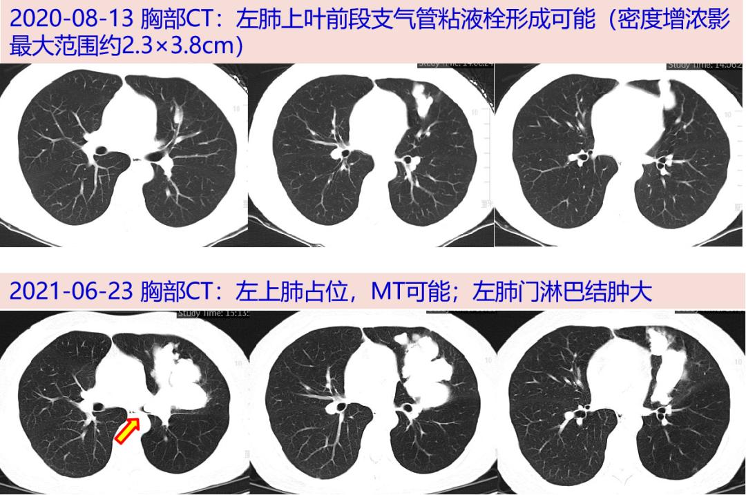 探案丨发现痰栓一年仅留一线的呼吸