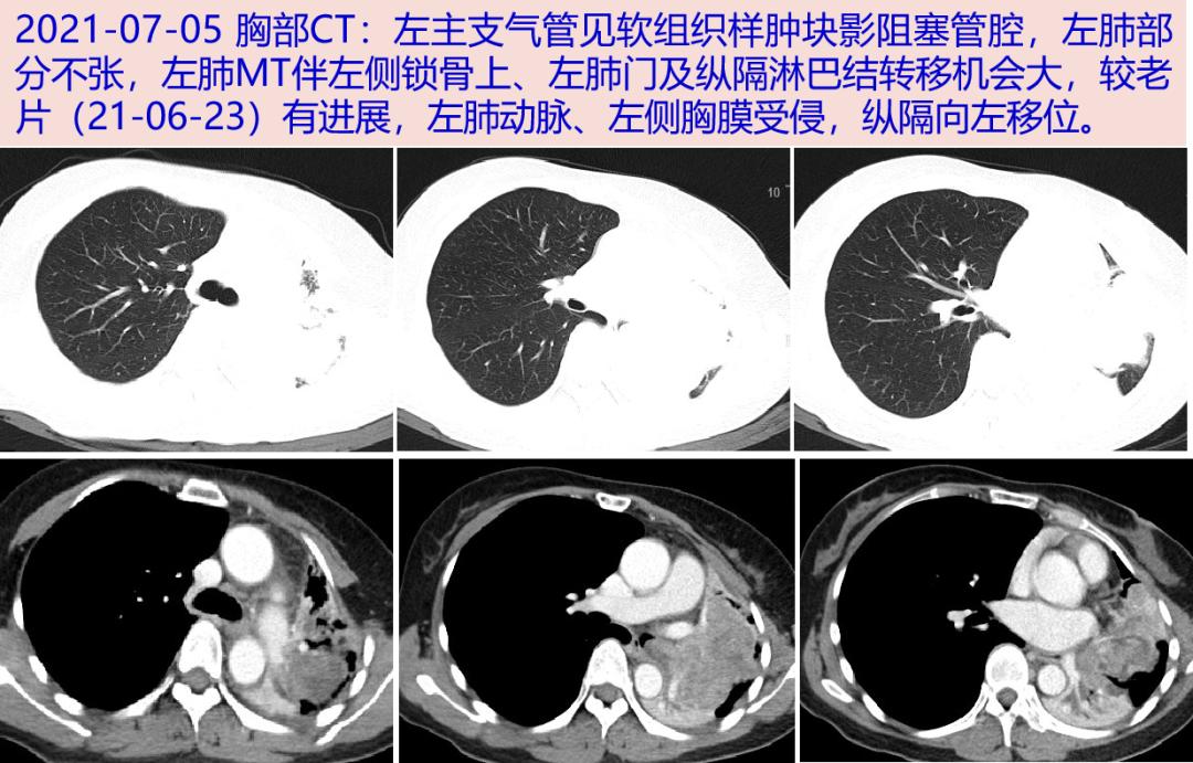 探案丨发现“痰栓”一年，仅留“一线” 的呼吸