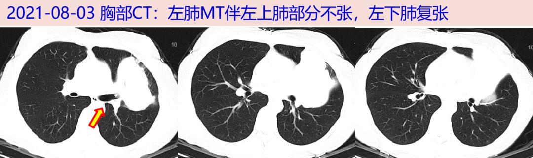 探案丨发现"痰栓"一年,仅留"一线" 的呼吸