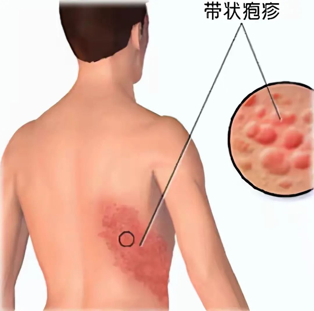 带状疱疹虽然以腰部多见,但也可以发生在其他部位,比如头面部,颈,胸
