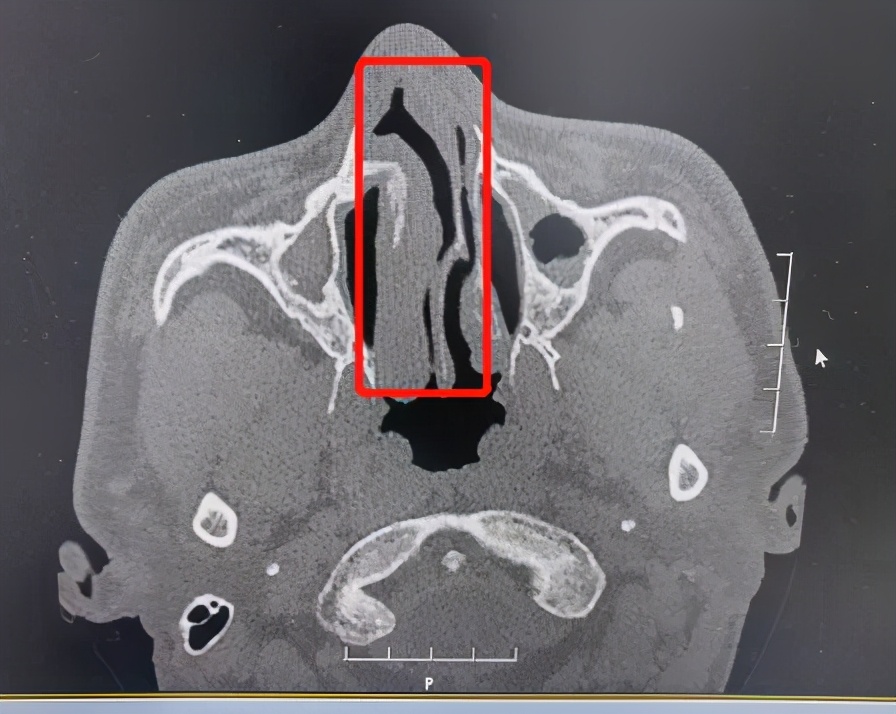 鼻中隔偏曲 deviation of nasal septum)是指鼻中隔偏向一侧或两侧