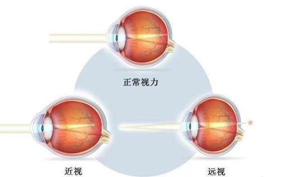 如下图所示:自然光线于正视眼,近视眼,远视眼在视网膜上的成像.