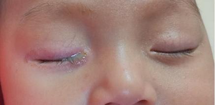 是发生于早产(胎龄新生儿泪囊炎,一般是由于眼睛与鼻子之间的泪道(即