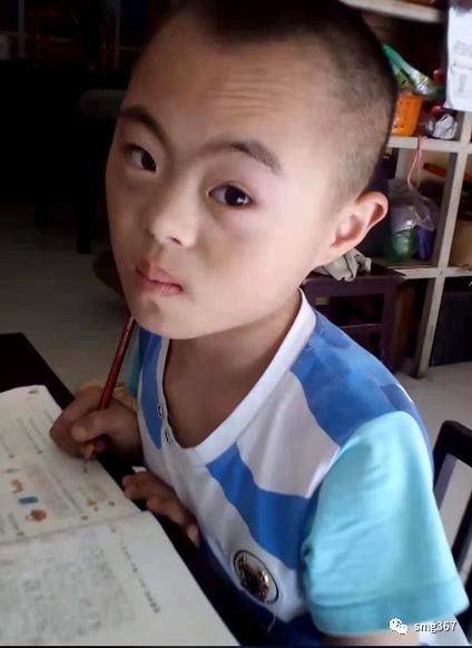 来自安徽金寨的杨杨是个唐氏综合征宝宝,染色体异常导致他的智力发展