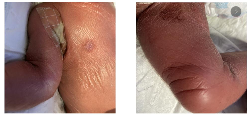 出生后全身皮肤呈羊皮纸样改变这类皮肤严重时可致死亡