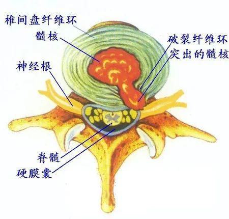 腰椎间盘突出症