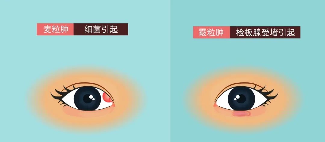 眼睛出现这些问题可能要手术治疗
