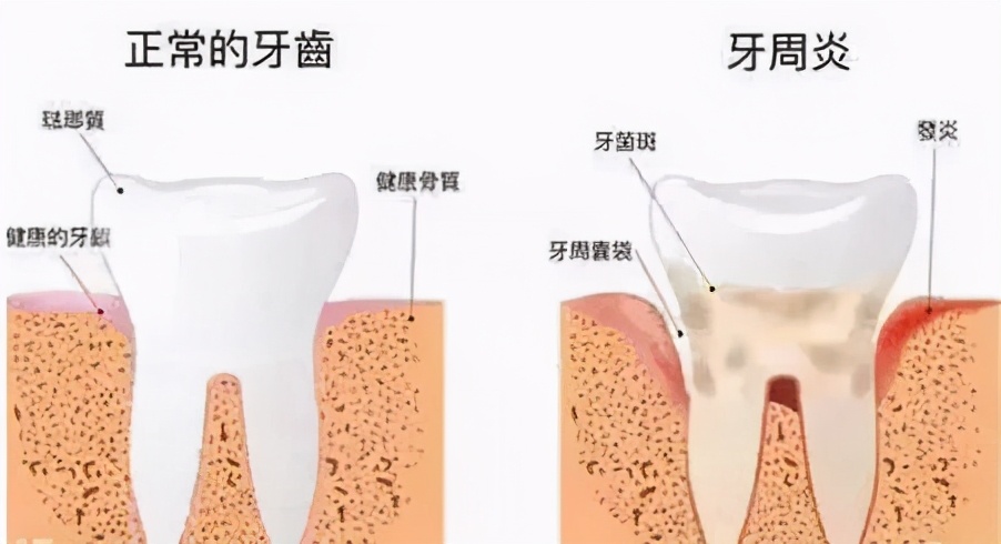 牙周膜息肉 治疗方法图片