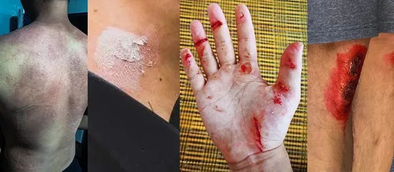 战疫民警伤口化脓,红斑,溃烂.