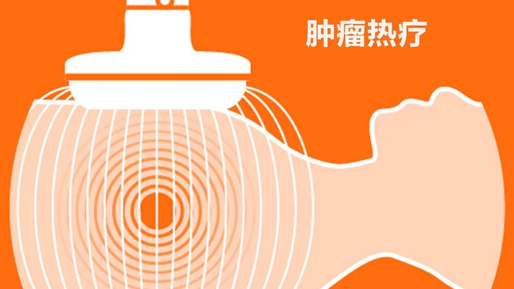 【健康科普】肿瘤热疗简介