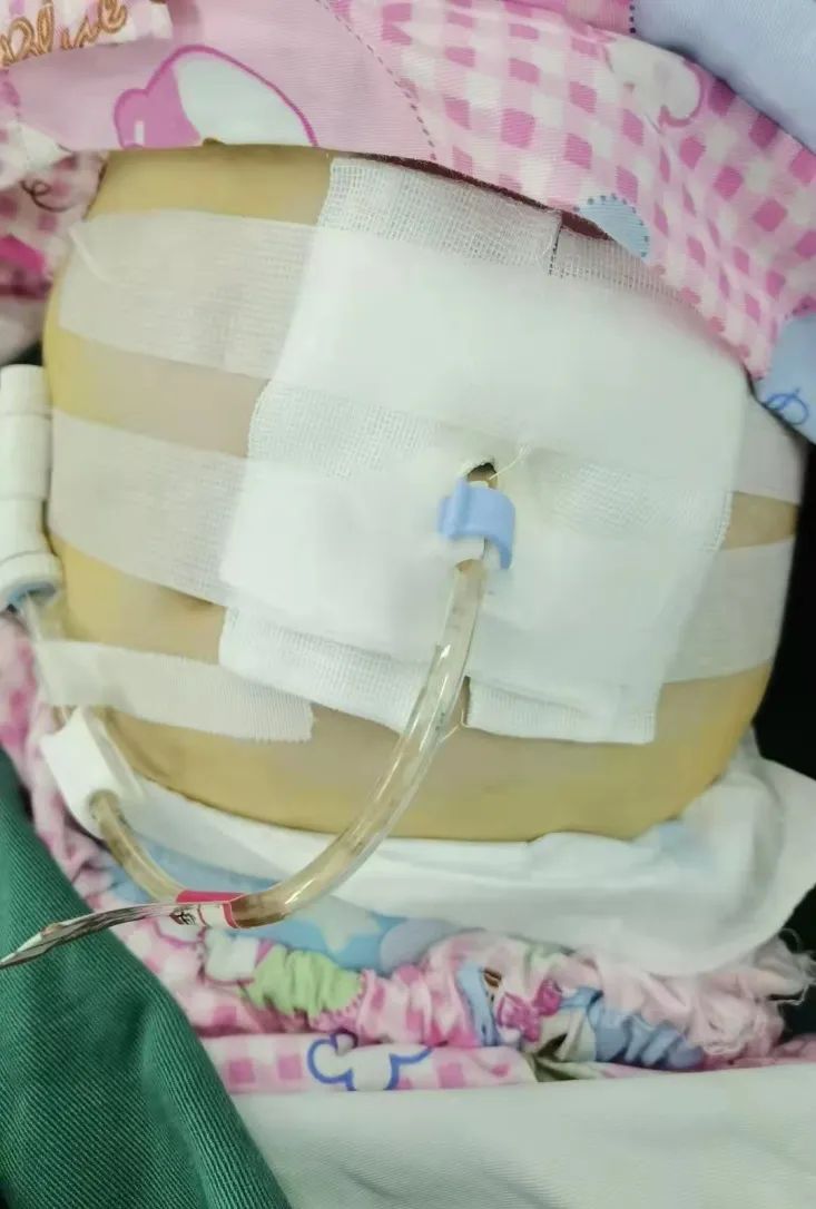 这种b超引导下的内镜手术让孩子少挨了一刀