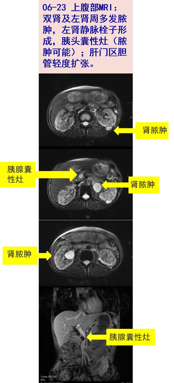 06-23 上腹部mri:双肾及左肾周多发脓肿,左肾静脉栓子形成,胰头囊性灶