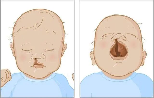 河北省儿童医院整形外科主任张文显提醒广大家长:唇腭裂往往伴发多种