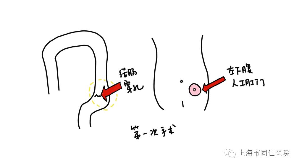 乙状结肠造口位置图片