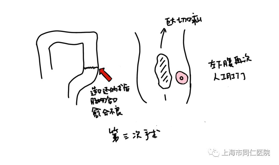 回肠造口回纳术步骤图图片