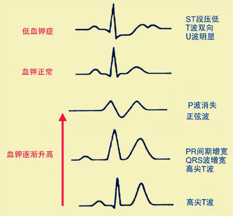 高血钾的心电图特点图片