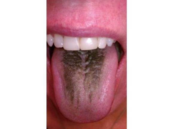舌苔发黑图片怎么回事图片