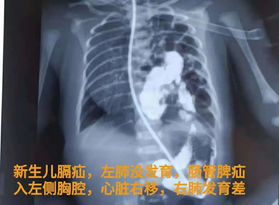 刻不容缓为危重患儿实施胸腔镜微创手术