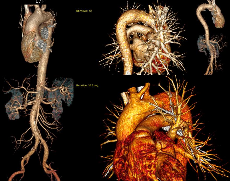 主动脉疾病的仿真三维ct发现病变