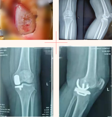 膝关节外科的 补牙 技术 膝关节单髁置换术