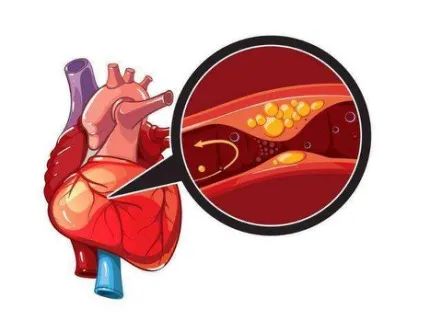 高血压,高血脂竟会撕裂这根大动脉