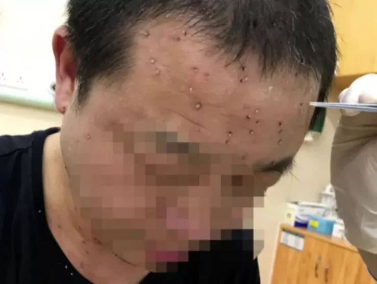 过程中遭遇蜜蜂攻击,脖子,背部等部位密密麻麻都是被蜜蜂蜇过的伤口