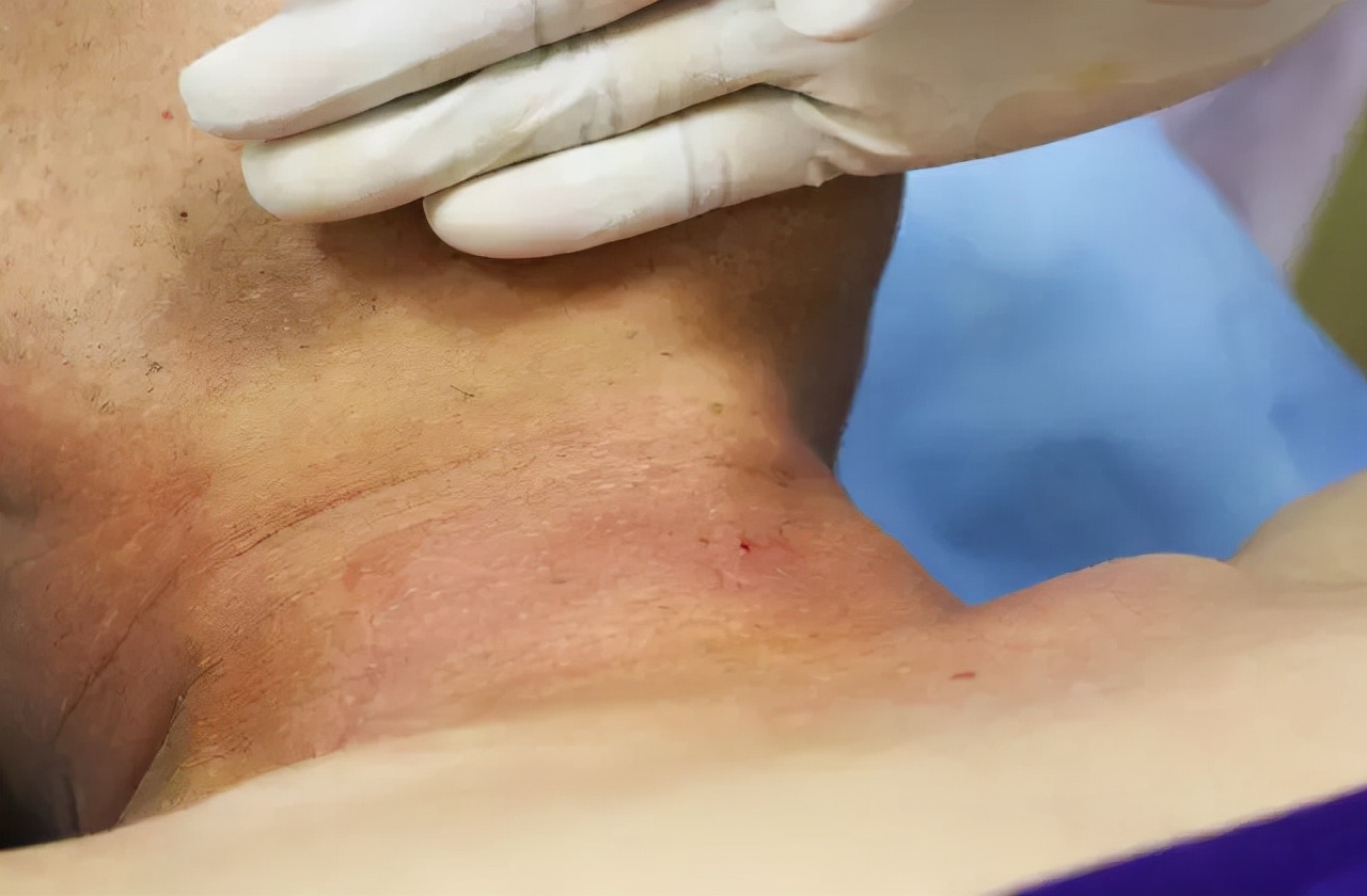 甲状腺结节咋破多学科专家教你这么解读