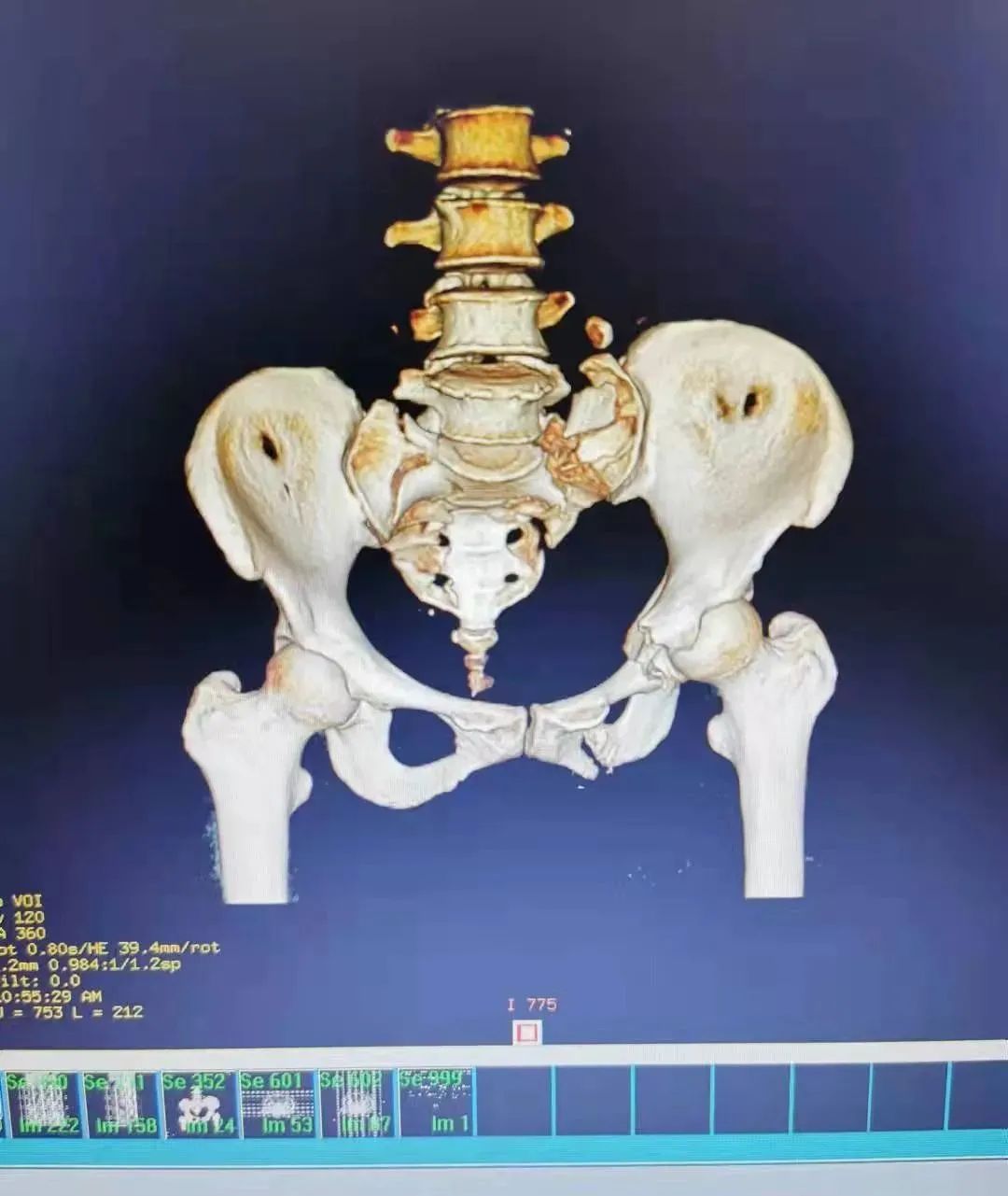 骨盆病状图片图片