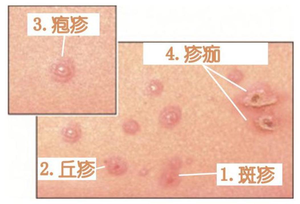 水痘和疹子的区别图片