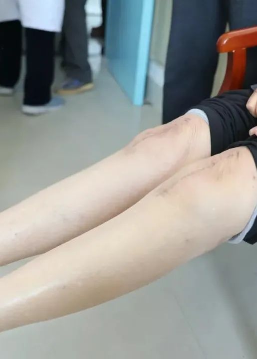 o型腿no可能是关节炎