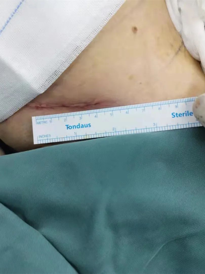 腔镜手术治愈40年的心头病真好