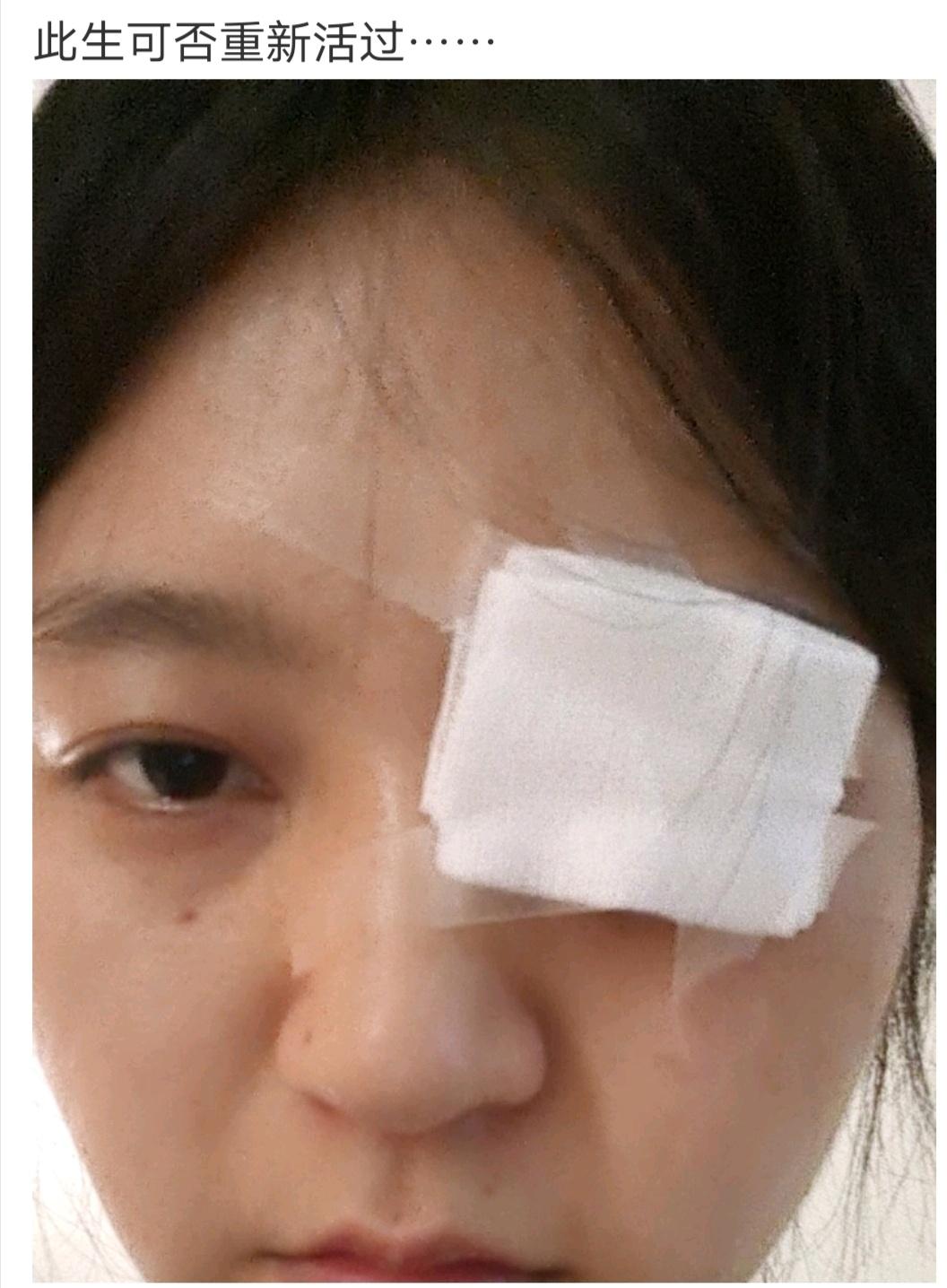 先是这个药,再是那个,然后要像这样把眼睑拉起来把药包住,再包纱布