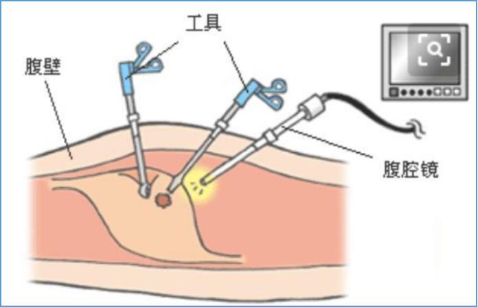 腹腔镜手术孔的位置图图片