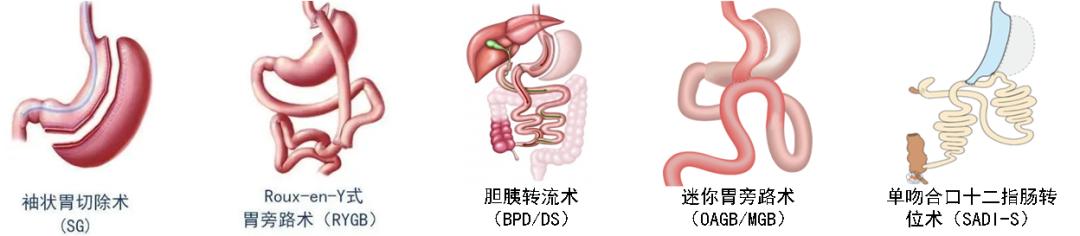 减肥手术多少钱_手术减肥_减肥手术哪种效果好