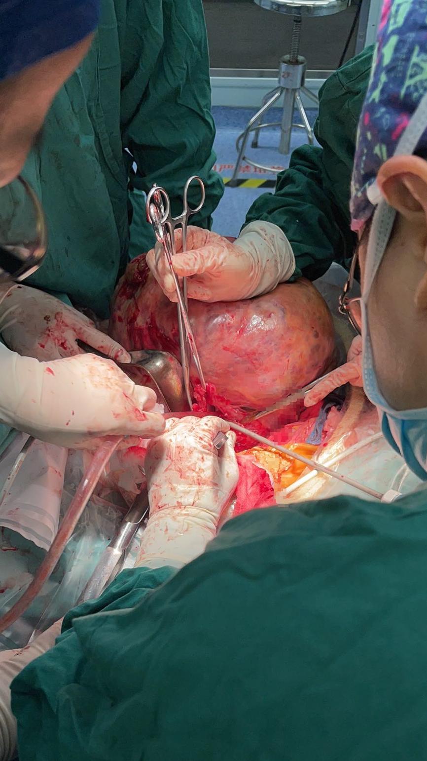 第一医疗精细分离边切边抽市一妇科团队手术摘除近40厘米巨大盆腔肿瘤