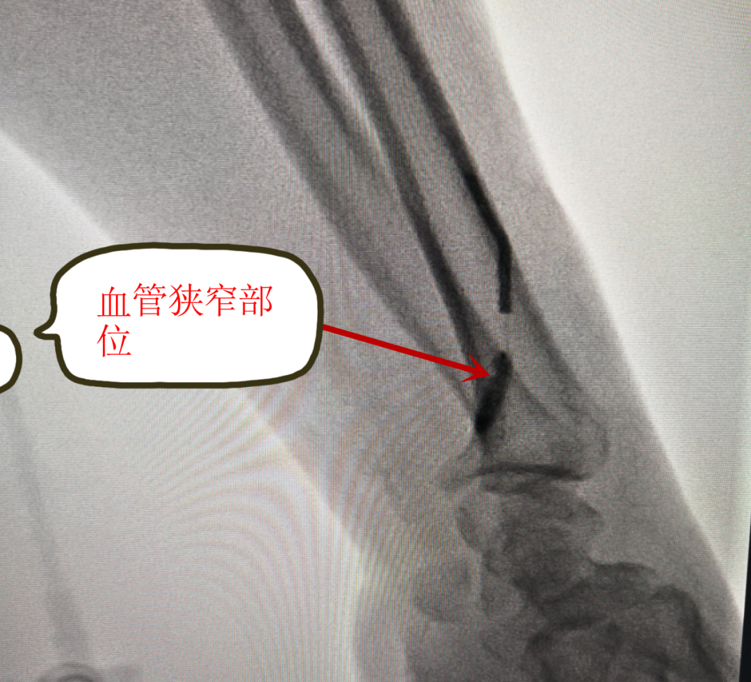 动静脉内瘘狭窄图片图片