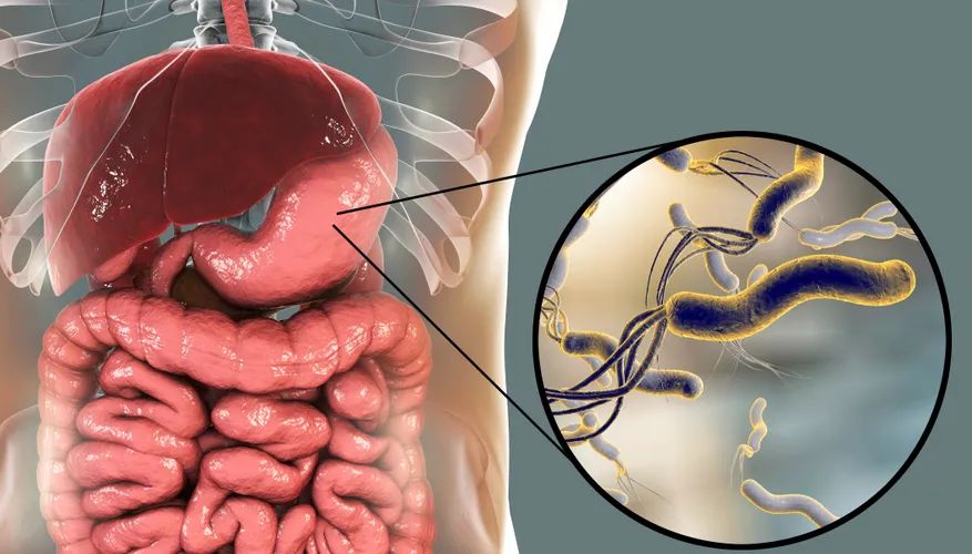 想要根治幽门螺杆菌你必须知道的3个谣言