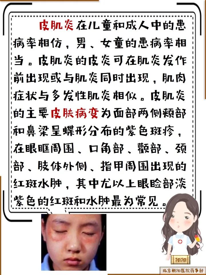 多发性肌炎和皮肌炎的治疗