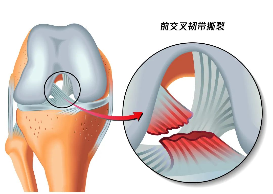 膝关节扭伤后,稳固关节的韧带和肌腱发生撕裂甚至断裂,如果不及时恢复