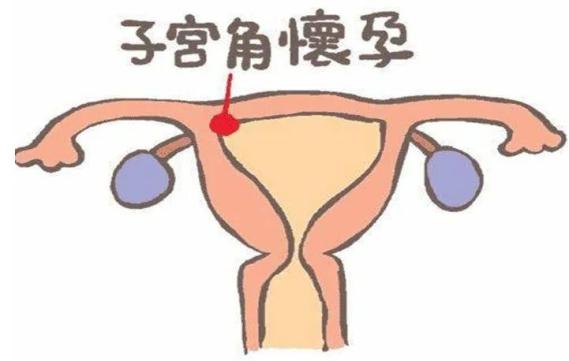 宫角妊娠位置图片