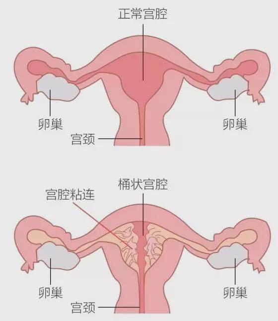 是多种原因导致的子宫内膜基底层损伤