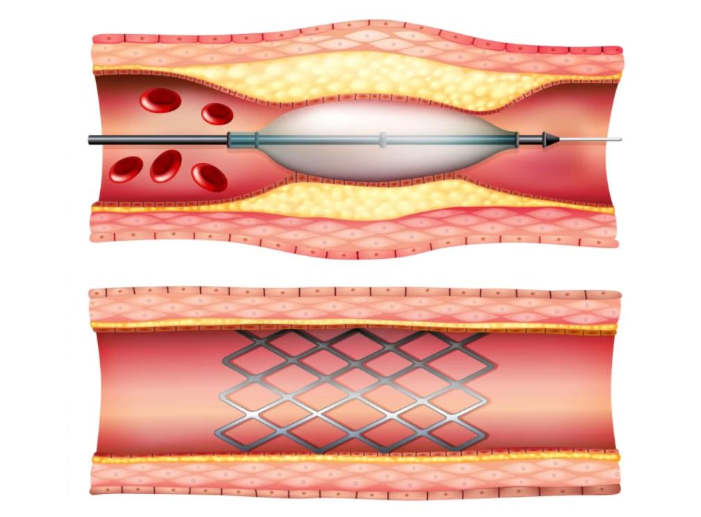 血管支架过程示意图图片