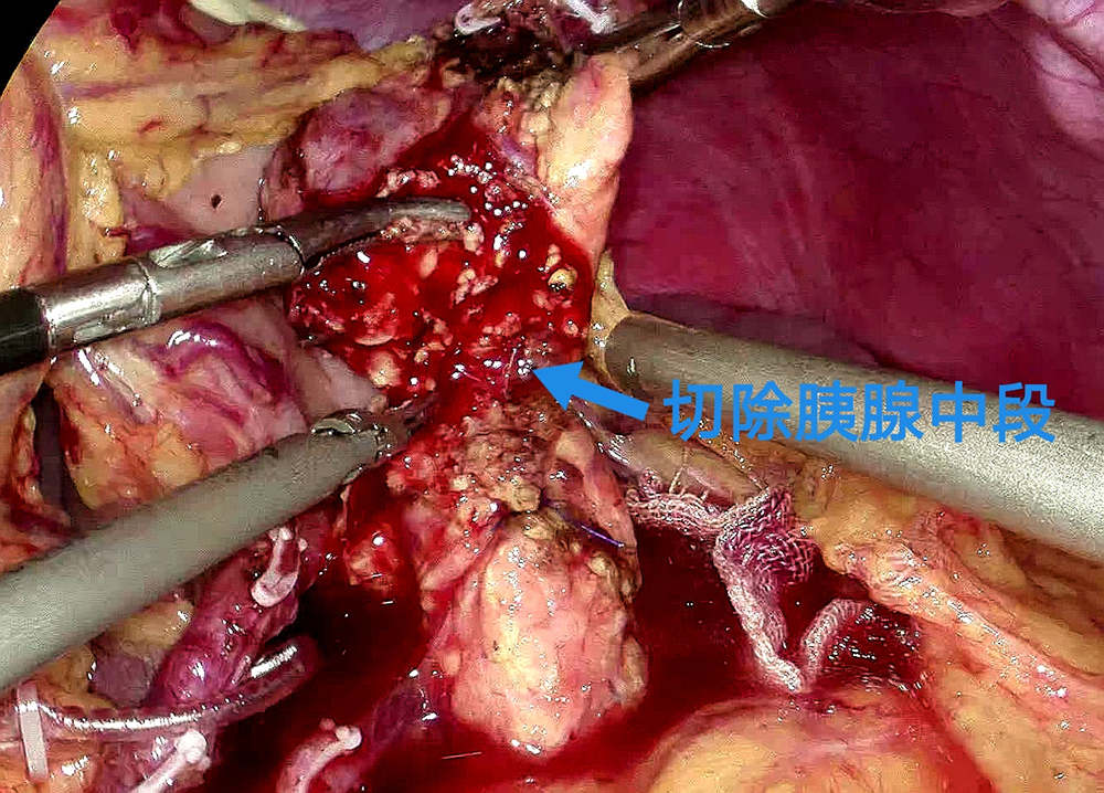 胰路前行,百色市人民醫院成功實施全腹腔鏡下胰腺中段切除術