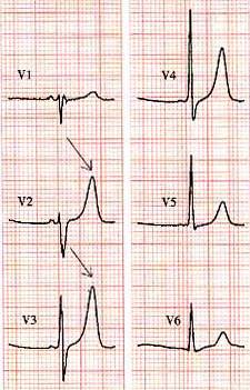 t波高尖心电图图片图片