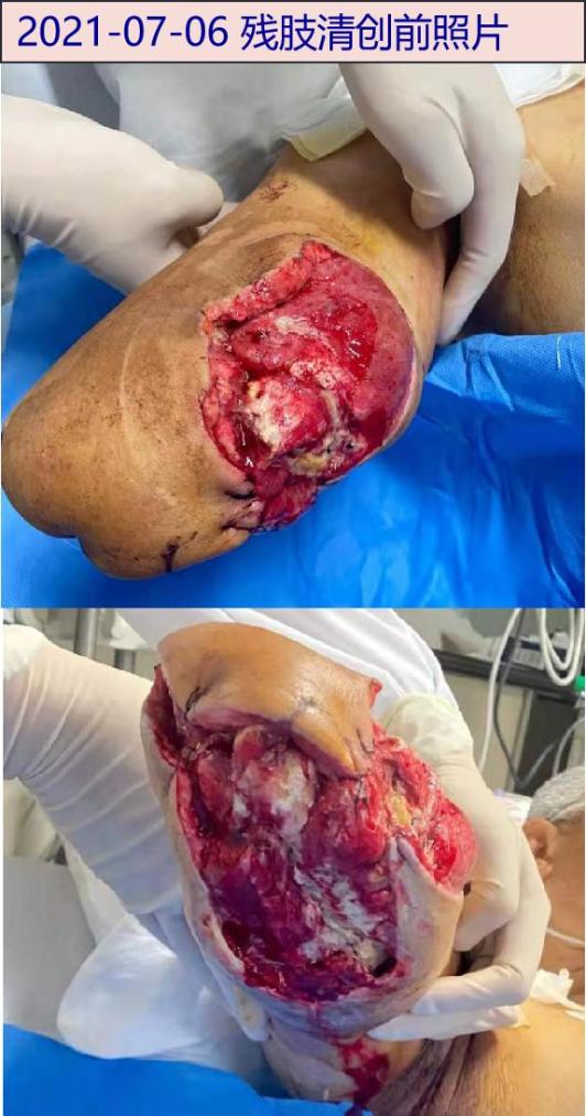 5g qd,头孢曲松2g qd抗感染,继续vsd,恩替卡韦抗病毒,升血小板,营养