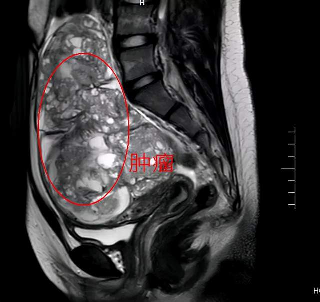 12岁女生大个肚子一查竟是卵巢肿瘤家长注意