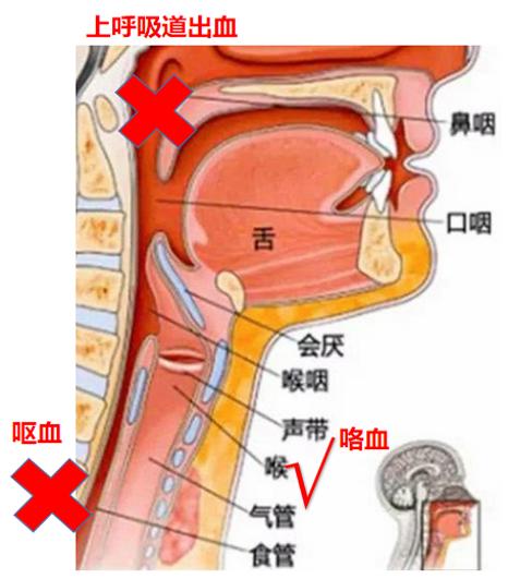 咯血是指喉及其以下呼吸道或肺組織出血,經口咳出.