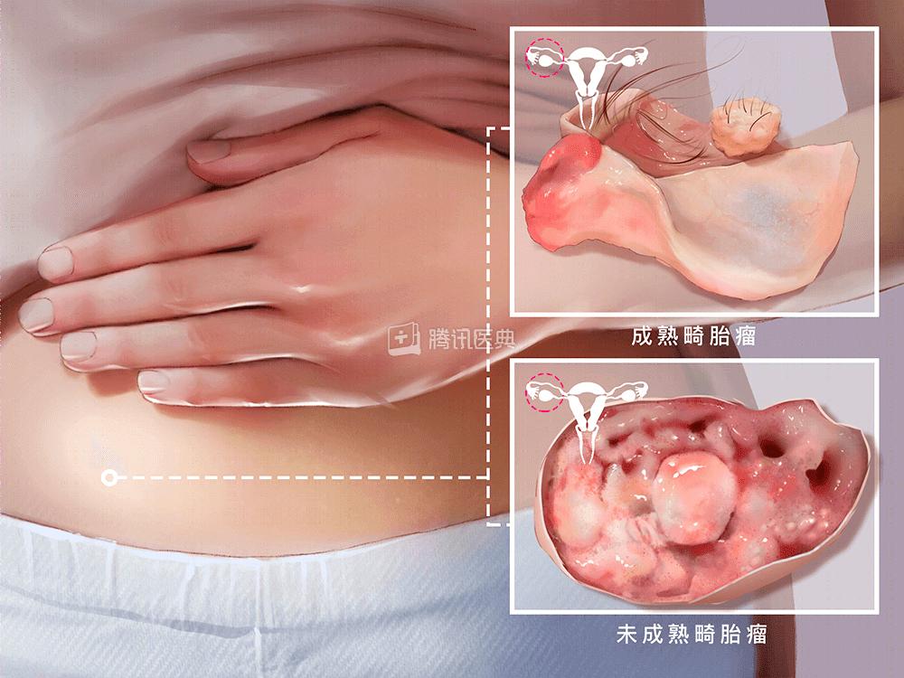 卵巢囊肿肚子照片图片